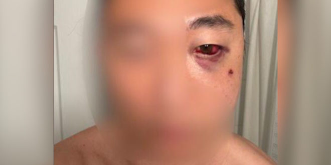 Asian American Sucker Punched In Central Park