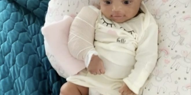 3 month old daughter arm broken