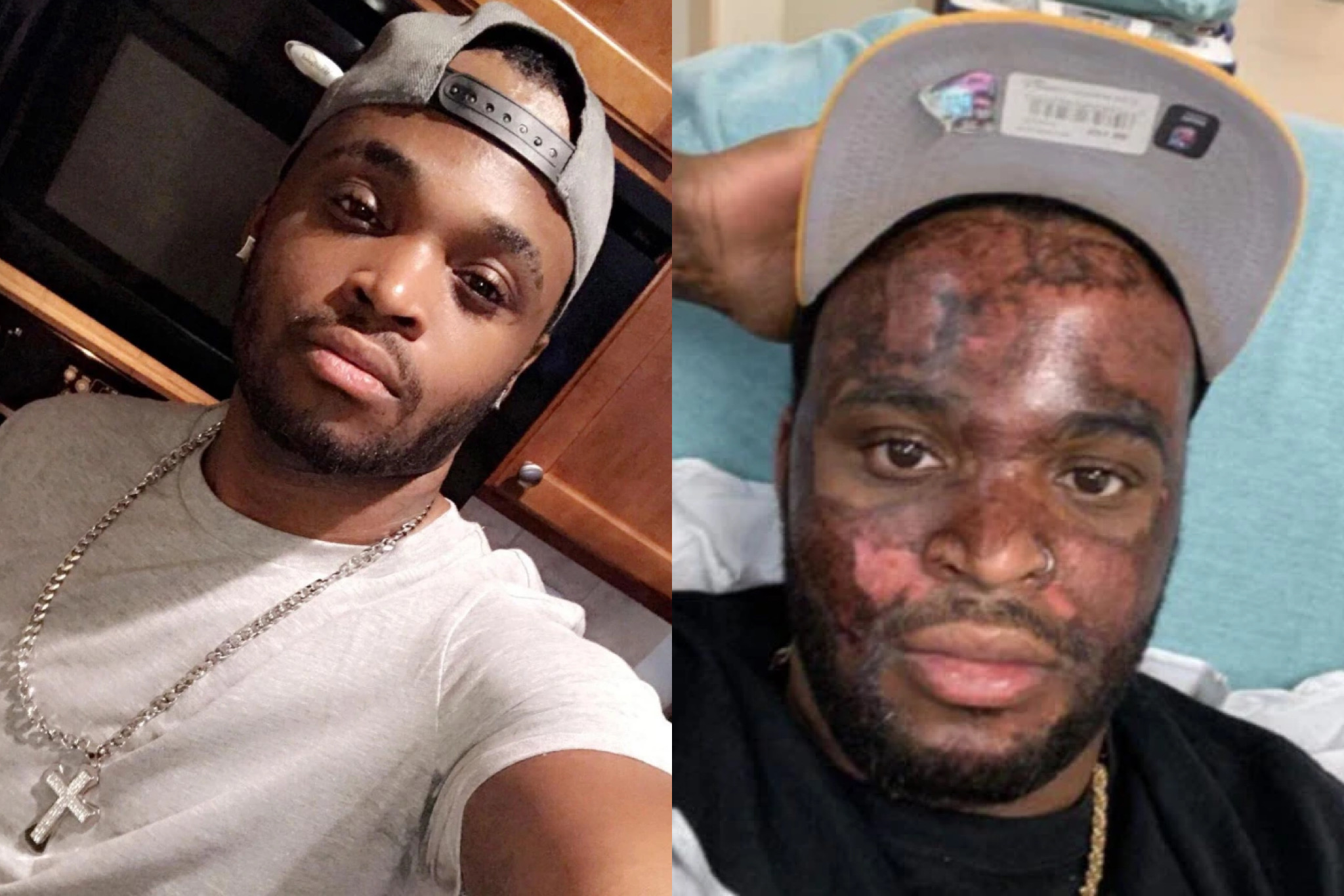 Neyo White Chemical Peel