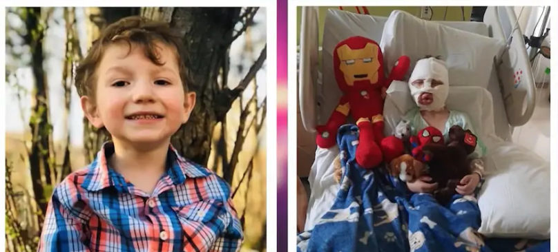 Six-Year-Boy Set On Fire By Neighborhood Bully In Deliberate Attack