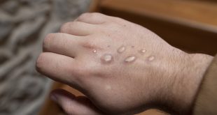 Monkeypox Cases on the Rise in Florida