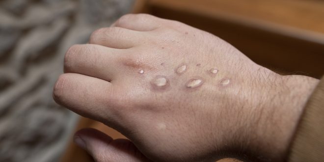 Monkeypox Cases on the Rise in Florida