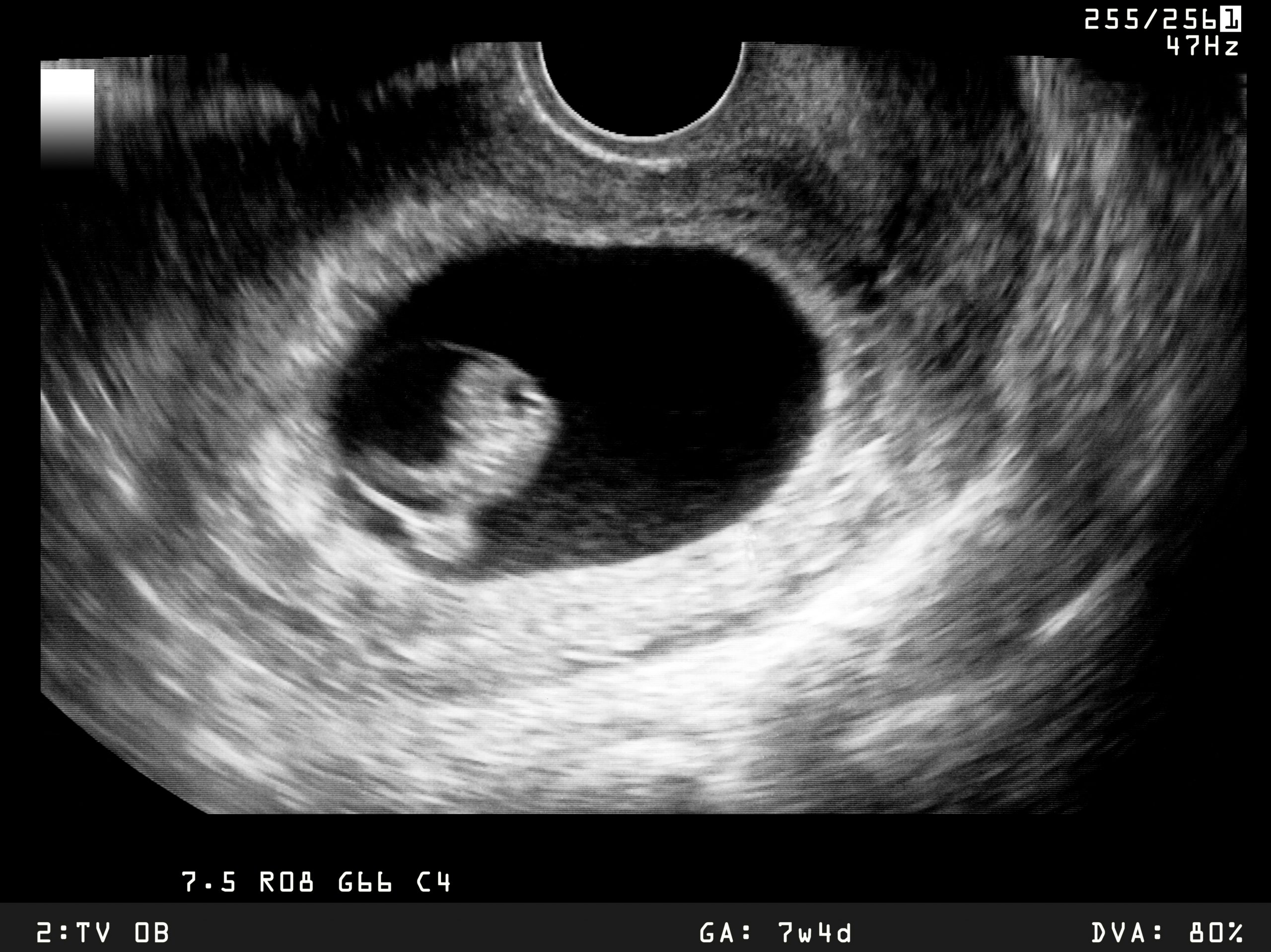 Ultrasound showing early stage of embryo development - Baller Alert Georgia Residents Now Allowed to Claim Embryos As Dependents On Their State Taxes