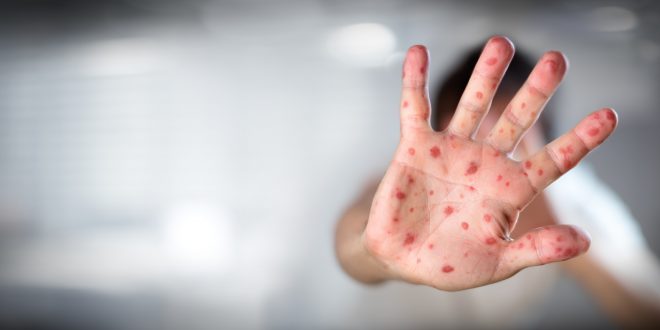WHO and CDC Says COVID Is To Blame For Measles Being An "Imminent Threat" Worldwide