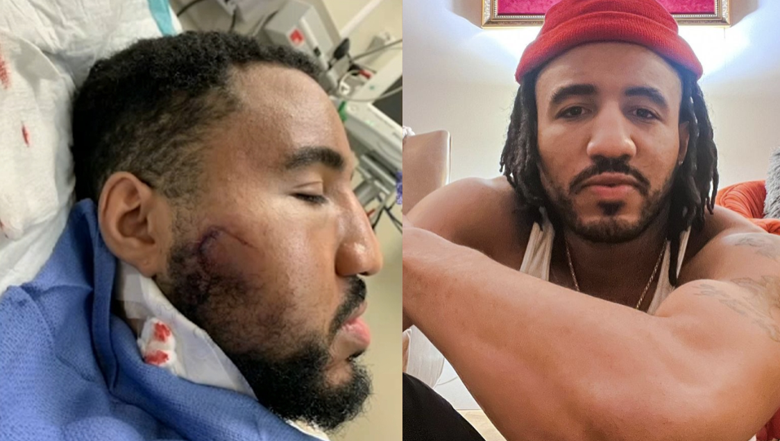 Jury Awards $375,000 To Man Struck By LAPD Rubber Bullet During 2020 George Floyd Protest