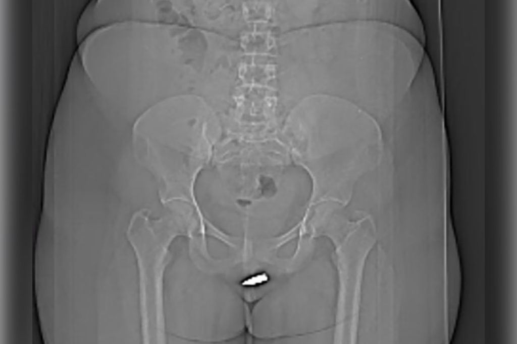 Woman With Bullet Stuck In Her Clitoris Is Healing Well After It Was Successfully Removed