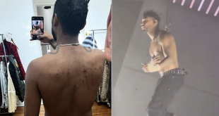 Miguel Shows The Aftermath Of His Back After Suspending Himself From Hooks Pierced into Skin During Concert Stunt [Video]