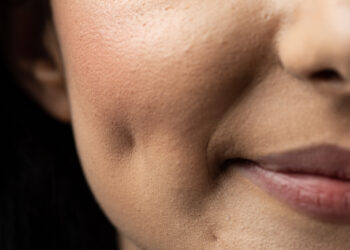 Dimple Surgery Is The Latest Cosmetic Craze, But Is It Worth It?