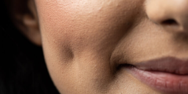 Dimple Surgery Is The Latest Cosmetic Craze, But Is It Worth It?