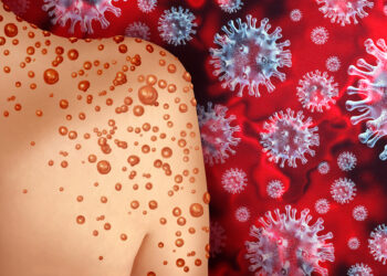 mpox