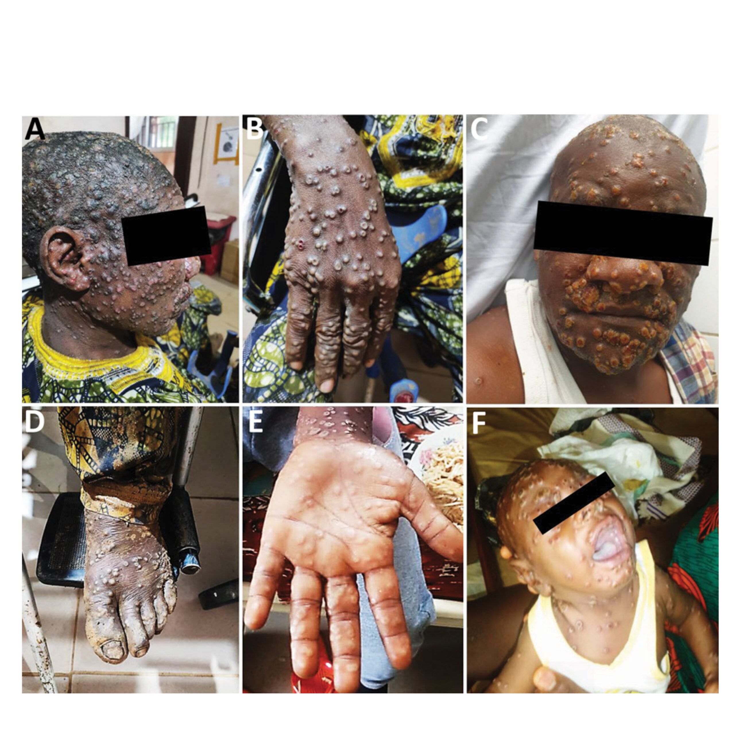 Shockwaves in Public Health: First U.S. Case of Severe Clade I Mpox Confirmed