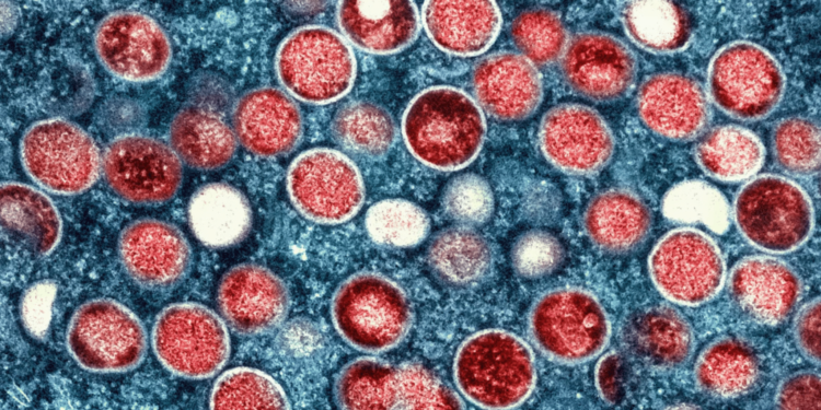 Shockwaves in Public Health: First U.S. Case of Severe Clade I Mpox Confirmed