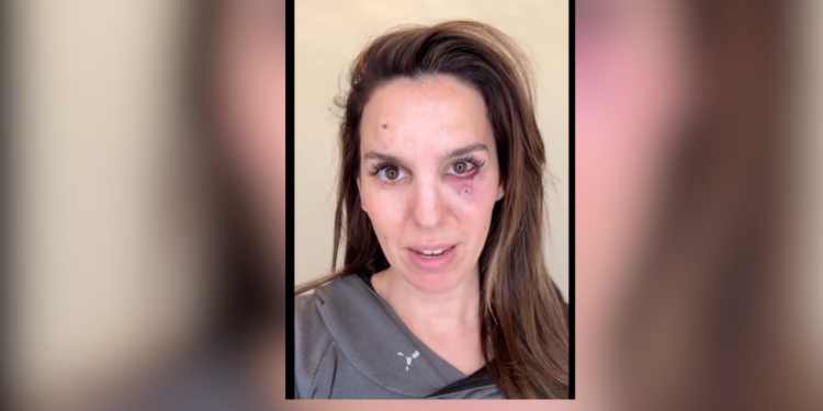Kim Possible Star Christy Carlson Romano - Baller Alert Kim Possible Star Christy Carlson Romano Shares Grateful Message After Being Shot in the Face