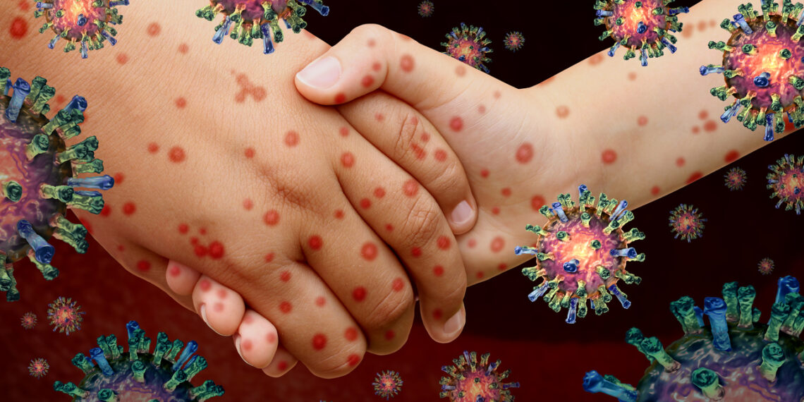 Pennsylvania Confirms First Measles Deaths In 35 Years, Both Patients Unvaccinated