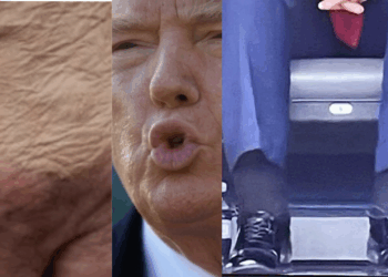 Trump Diagnosed With Vein Condition