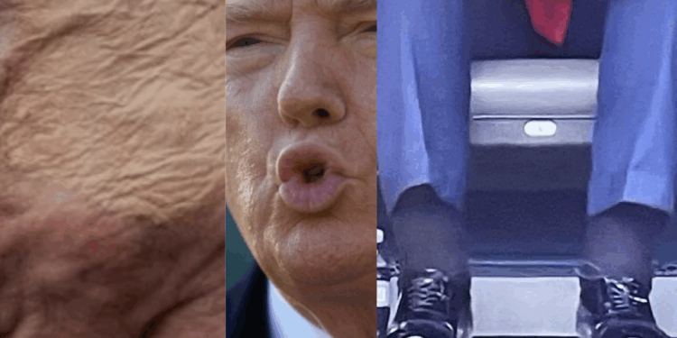 Trump Diagnosed With Vein Condition
