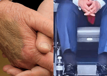 What is Chronic Venous Insufficiency