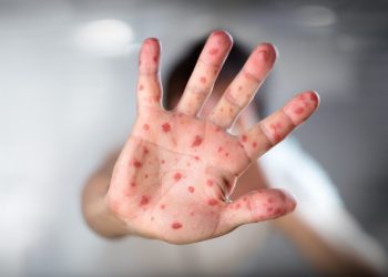 Measles Cases Are Surging Nationwide and The Real Numbers Might Be Higher