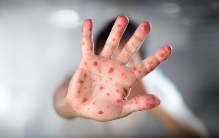The U.S. Hit 2,318 Measles Cases Before August, But The Real Outbreak May Be Even Bigger