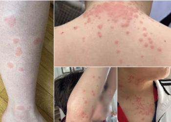 Family Alleges Flight Crew Silenced Them After Bed Bugs Attacked at 30,000 Feet -- Now They're Suing for $200,000