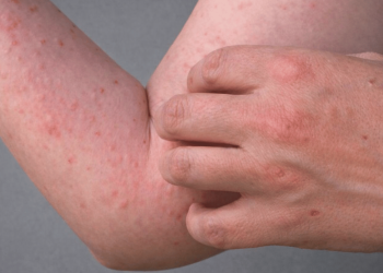 CDC Issues Level 2 Travel Warning for Seychelles as Virus Known for Crippling Joint Pain and Week-Long Fever Spreads