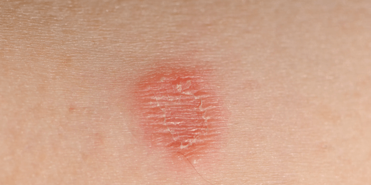 STD ringworm
