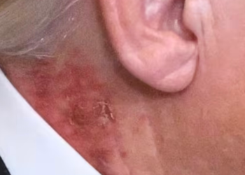 Trump neck rash