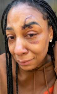 Close-up of a woman's face with a stitched scar along the right eyebrow and bruising under the eye, wearing a brown hoodie.