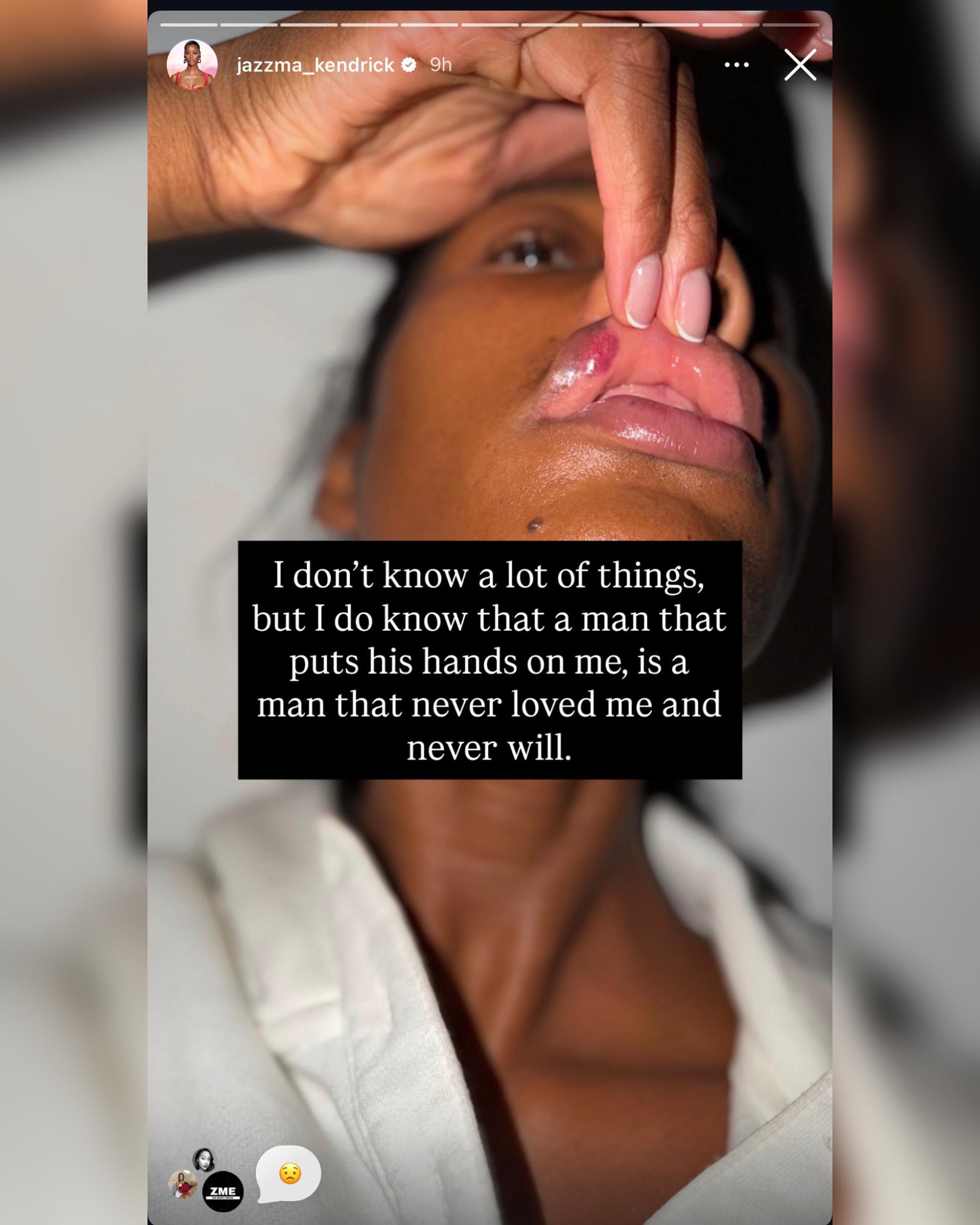 Jazzma Kendrick - Baller Alert Jazzma Kendrick Instagram story showing busted lip