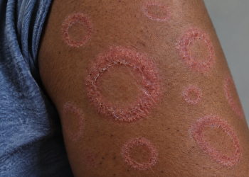 Drug Resistant Ringworm Is Spreading Fast And The Real Number Of Cases May Be Through The Roof