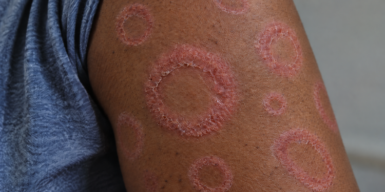 Drug Resistant Ringworm Is Spreading Fast And The Real Number Of Cases May Be Through The Roof